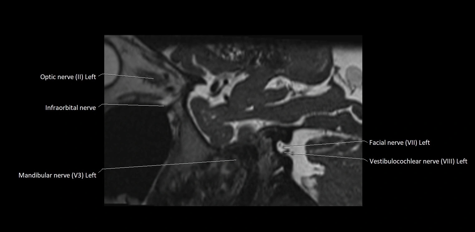 Cranial nerve sagittal anatomy MRI 3T image 14.webp